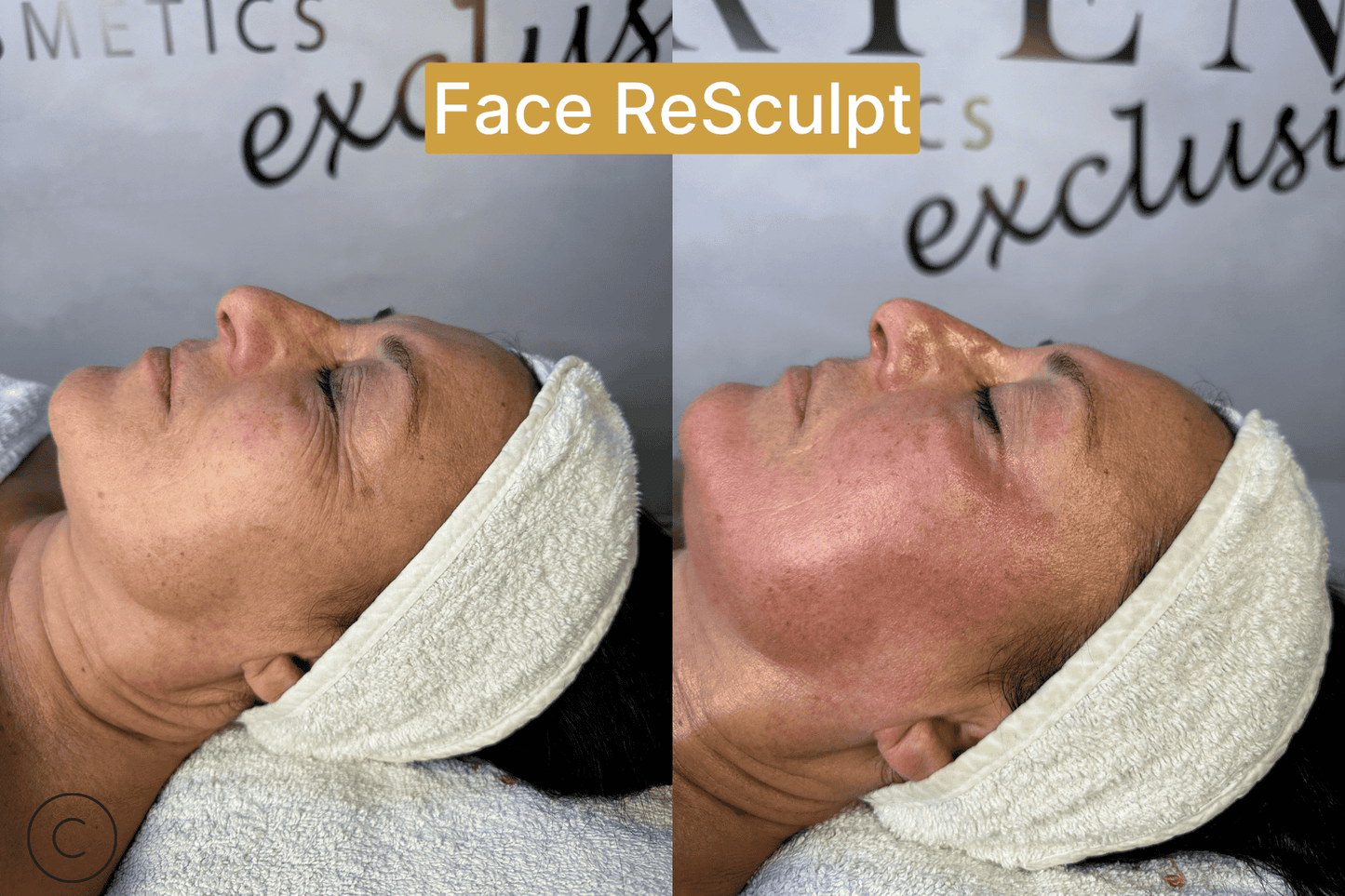 Face ReSculpt - Kurs Za Masažu Lica